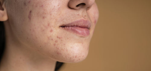 Comment éviter les boutons d'acné à la rentrée ?