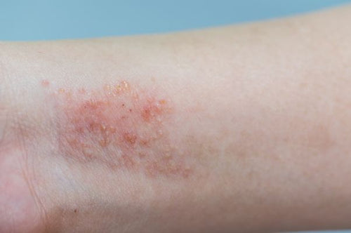 Quelle est la meilleure crème à la bave d’escargot pour les peaux atopiques ?