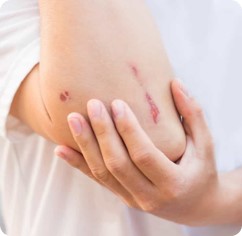 Cicatrices, blessures